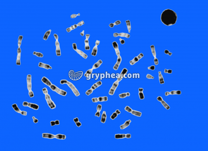 Trisomie 18 - gryphea.com